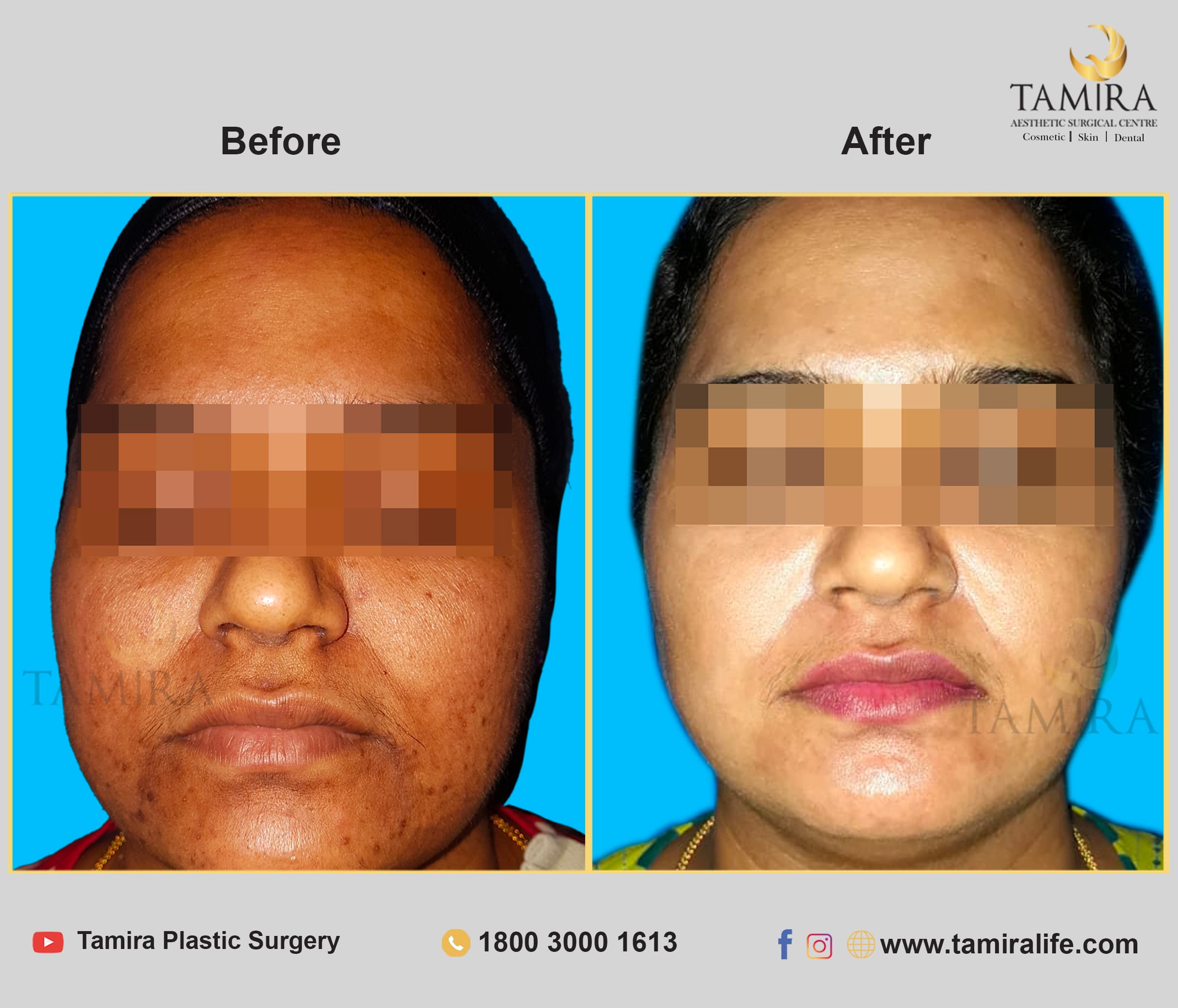 Microneedling - Before & After