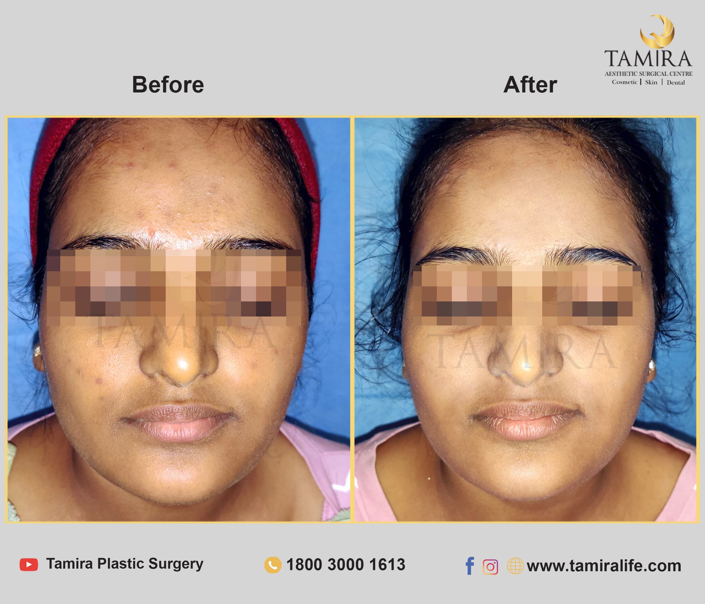 Hydra Facial - Before & After