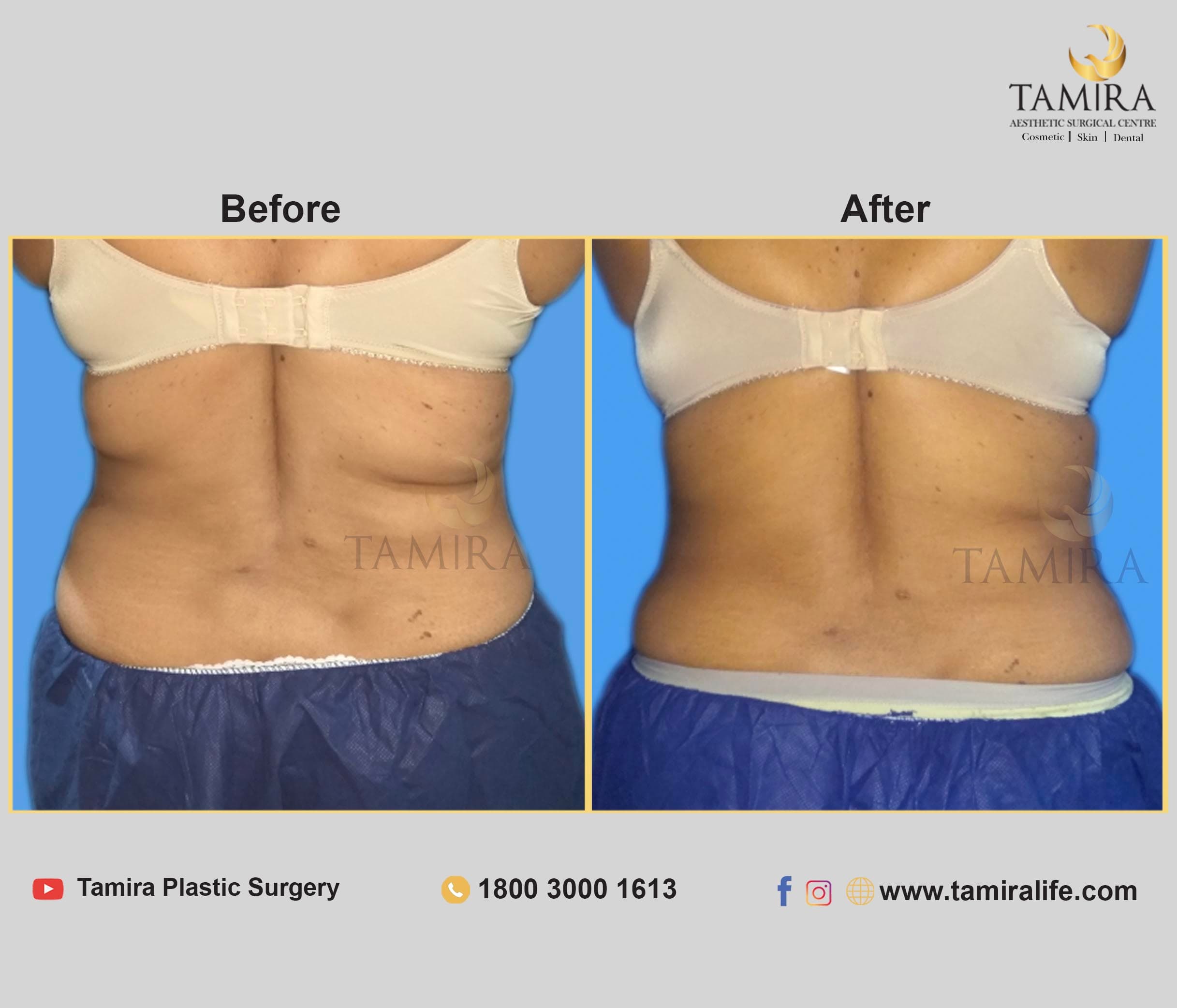 Coolsculpting - Before & After