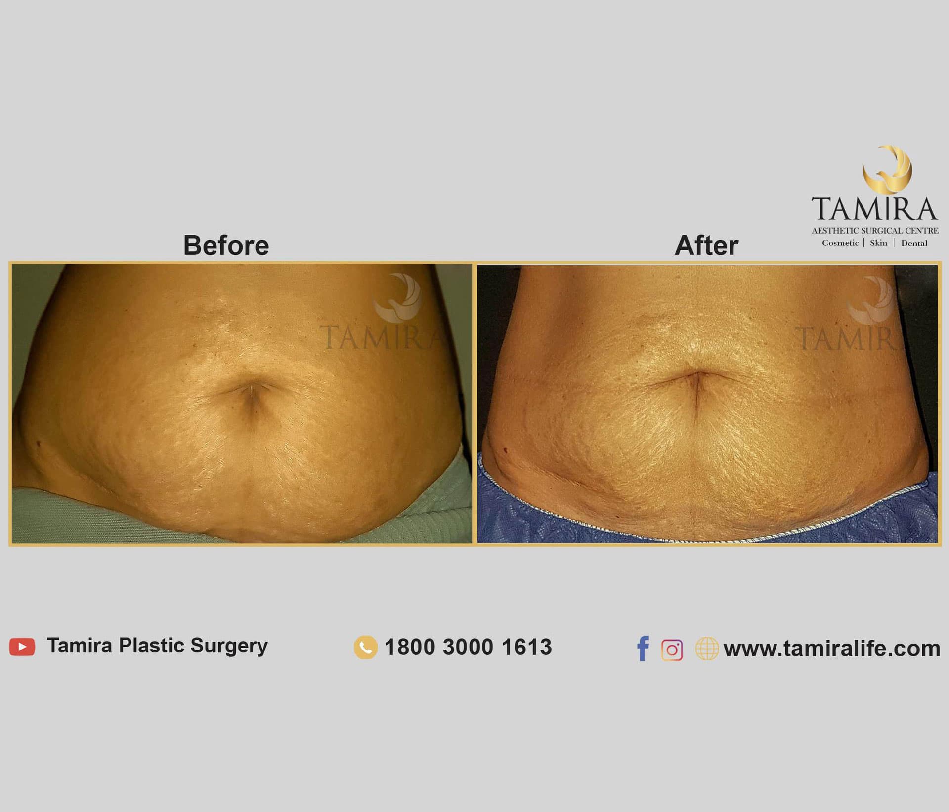 Coolsculpting - Before & After