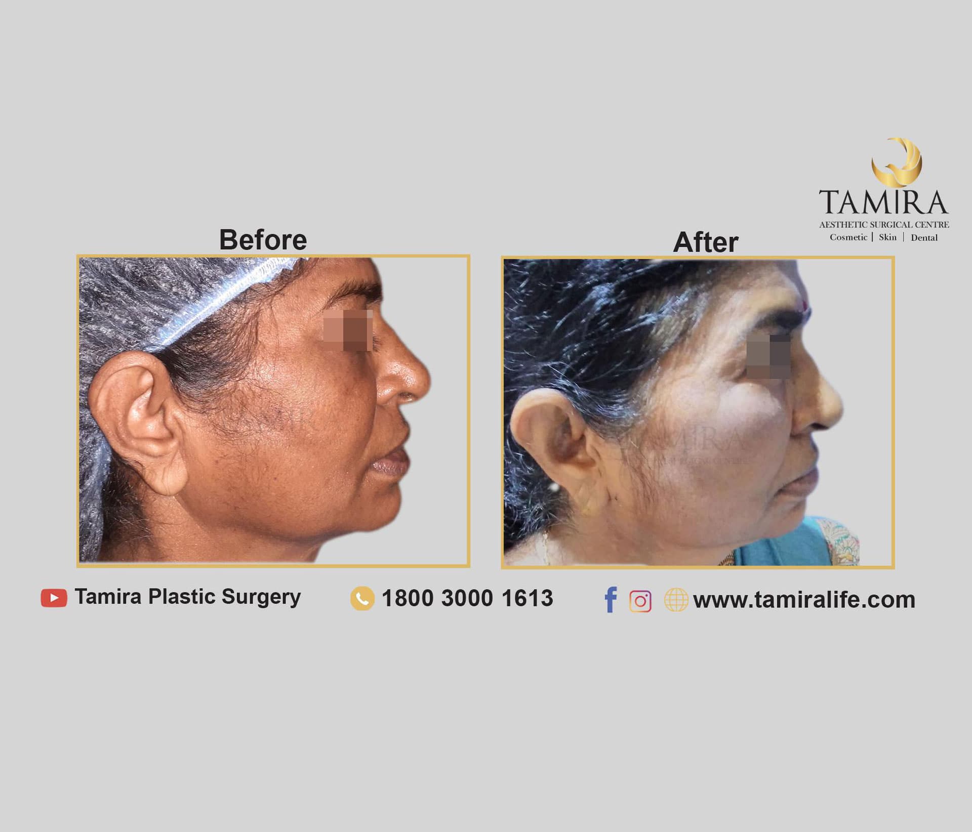 Invasive RF Skin tightening (Facetite/ Accutite / Necktite) - Before & After
