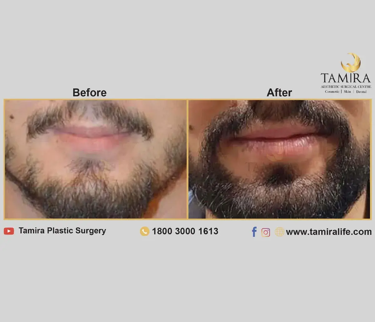 Beard Transplant - Before & After