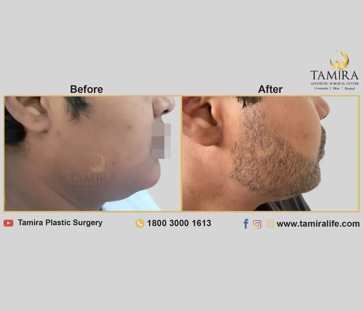 Beard Transplant - Before & After