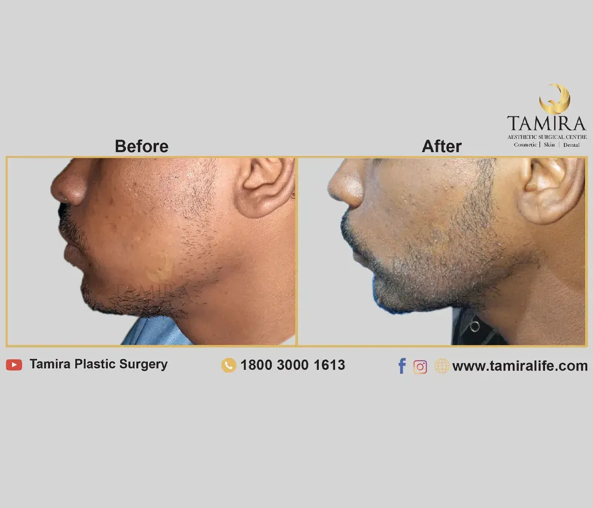 Beard Transplant - Before & After