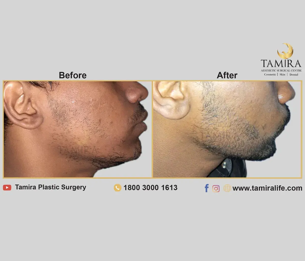 Beard Transplant - Before & After
