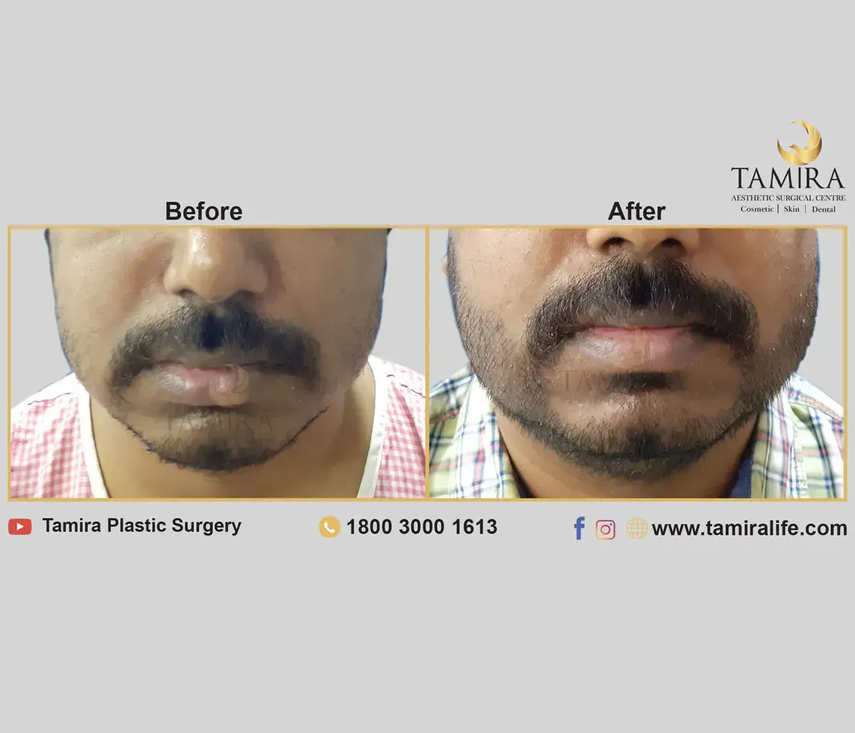 Beard Transplant - Before & After
