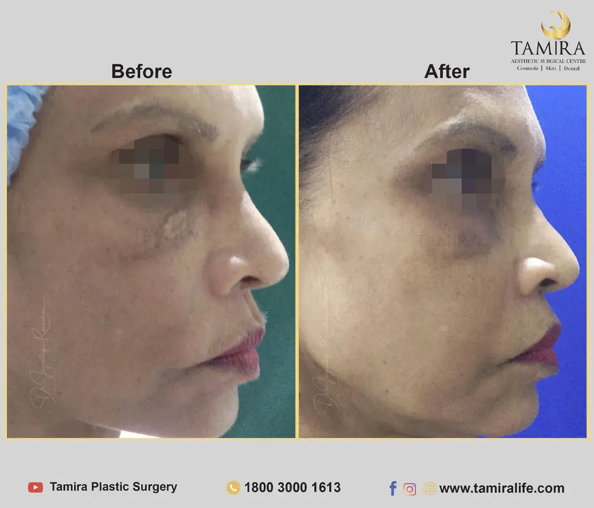 Facelift Surgery with Fat Grafting - Before & After