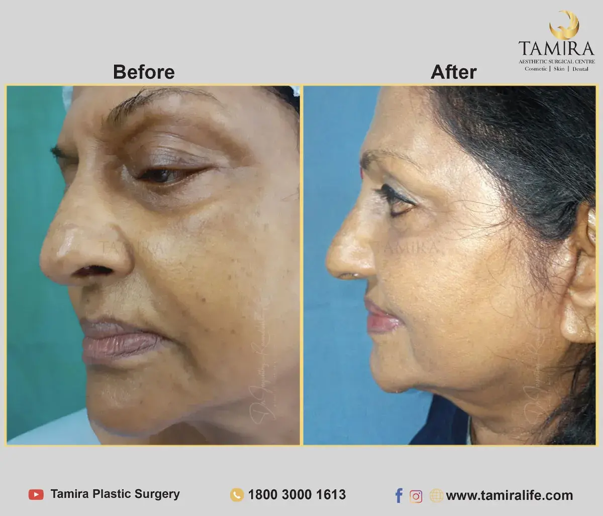 Facelift Surgery with Fat Grafting - Before & After