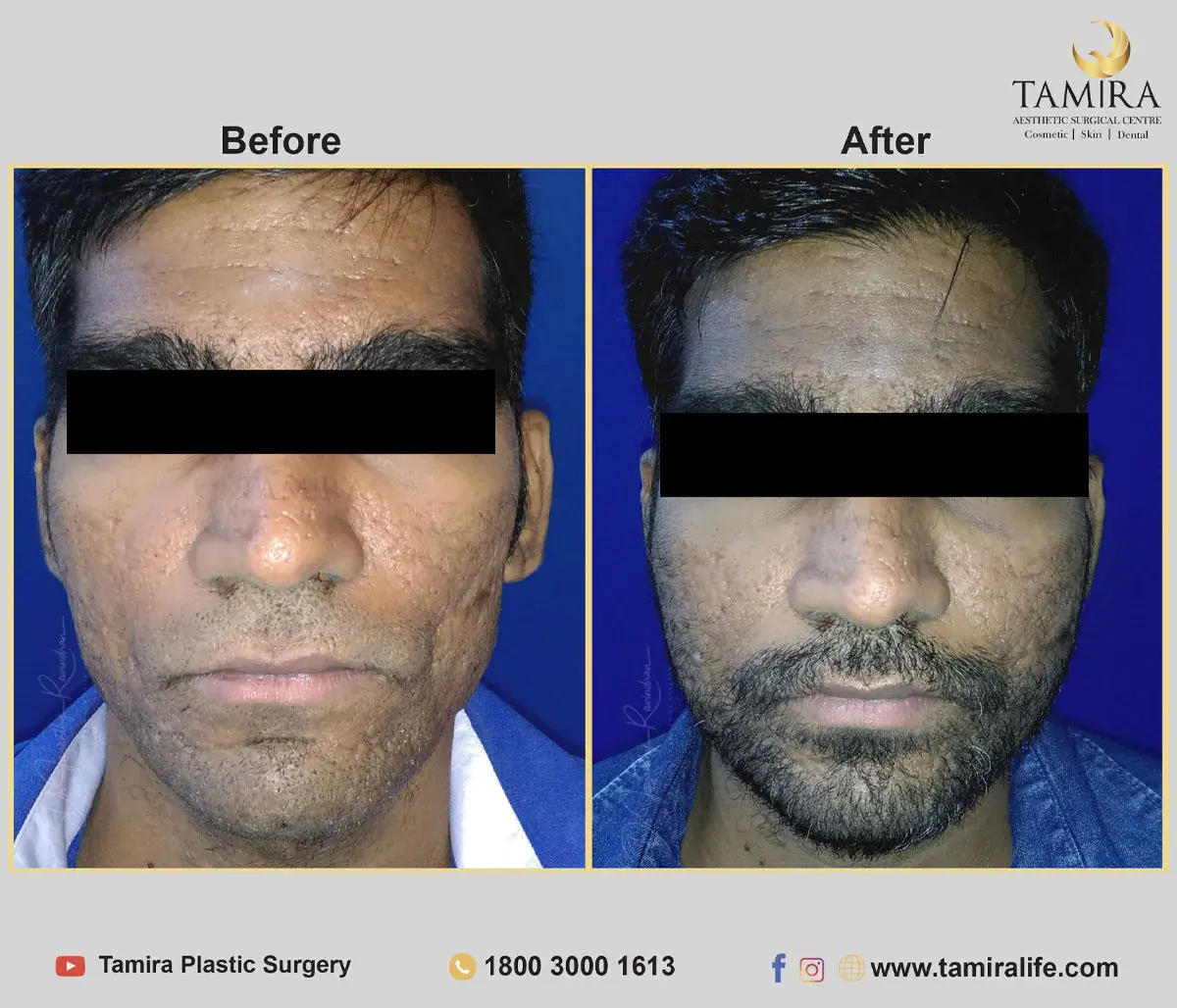 Facelift Surgery with Fat Grafting - Before & After
