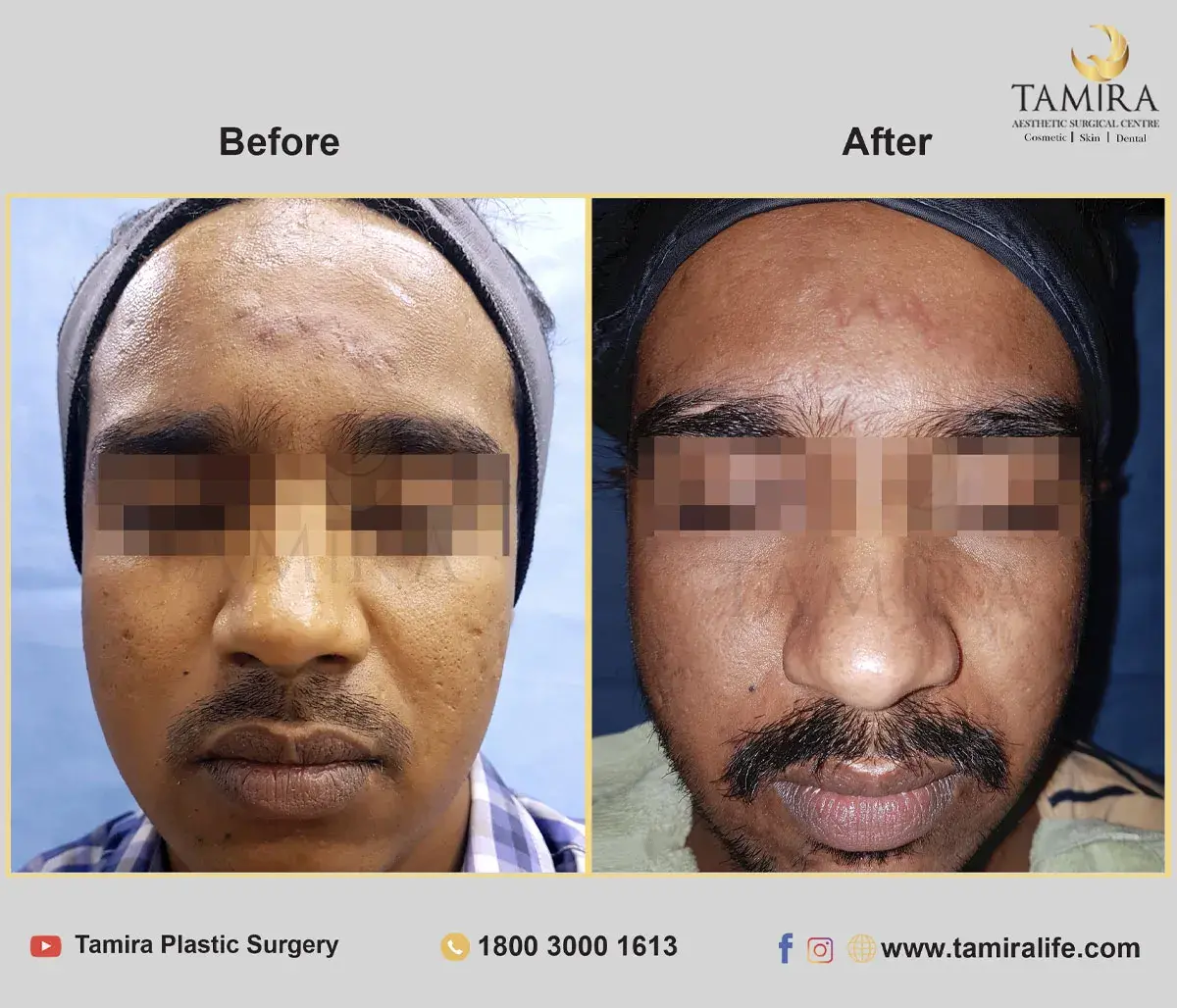 Laser treatment - Skin - Before & After