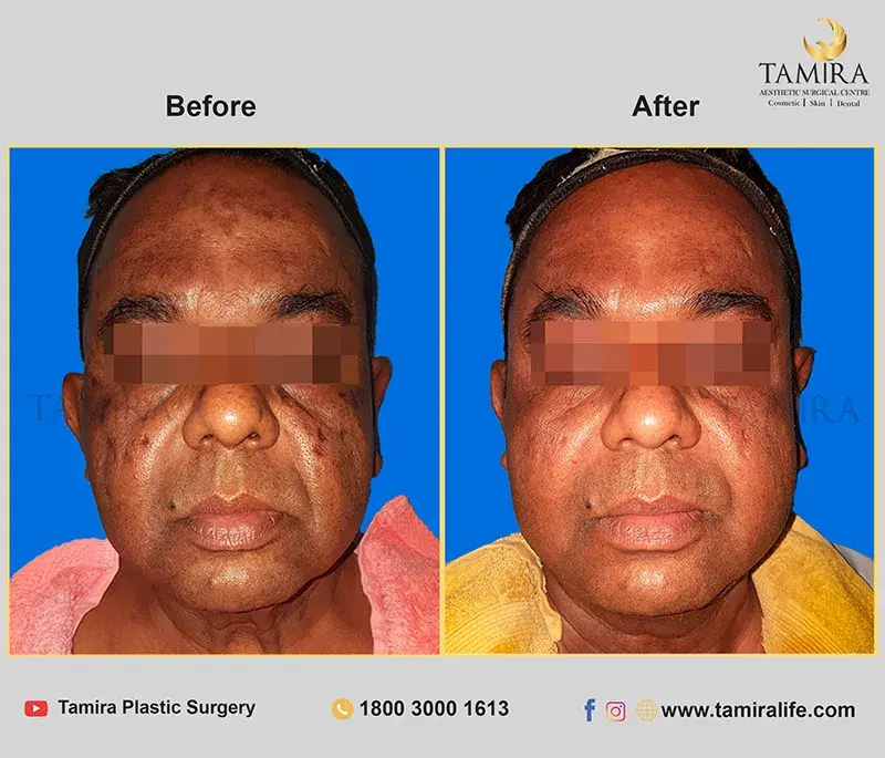 Non Invasive RF Skin tightening - Thermage - Before & After