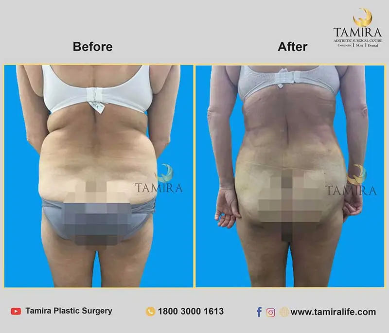 Liposuction - Buttocks - Before & After