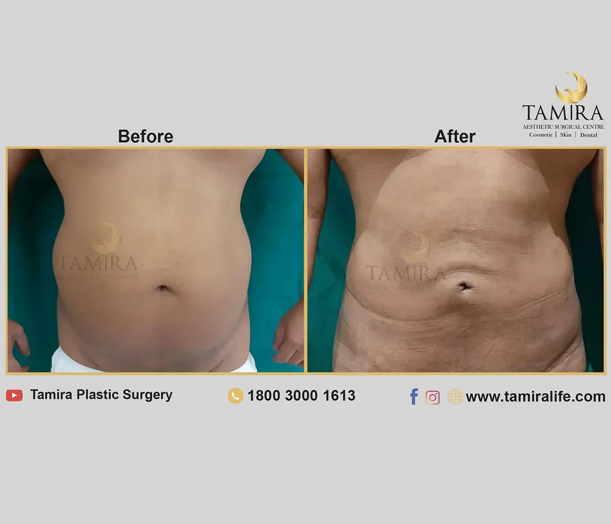 Liposuction - Abdomen - Before & After