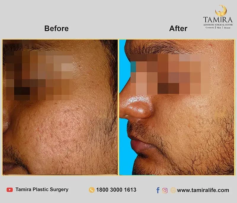 Radiotherapy - Before & After
