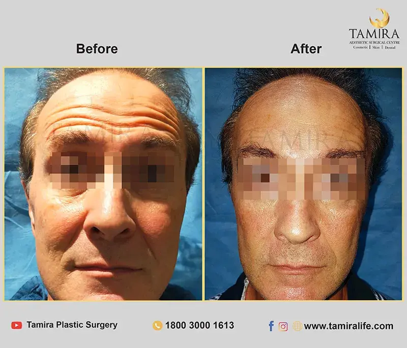 nueromodulator injections (botox) - Before & After