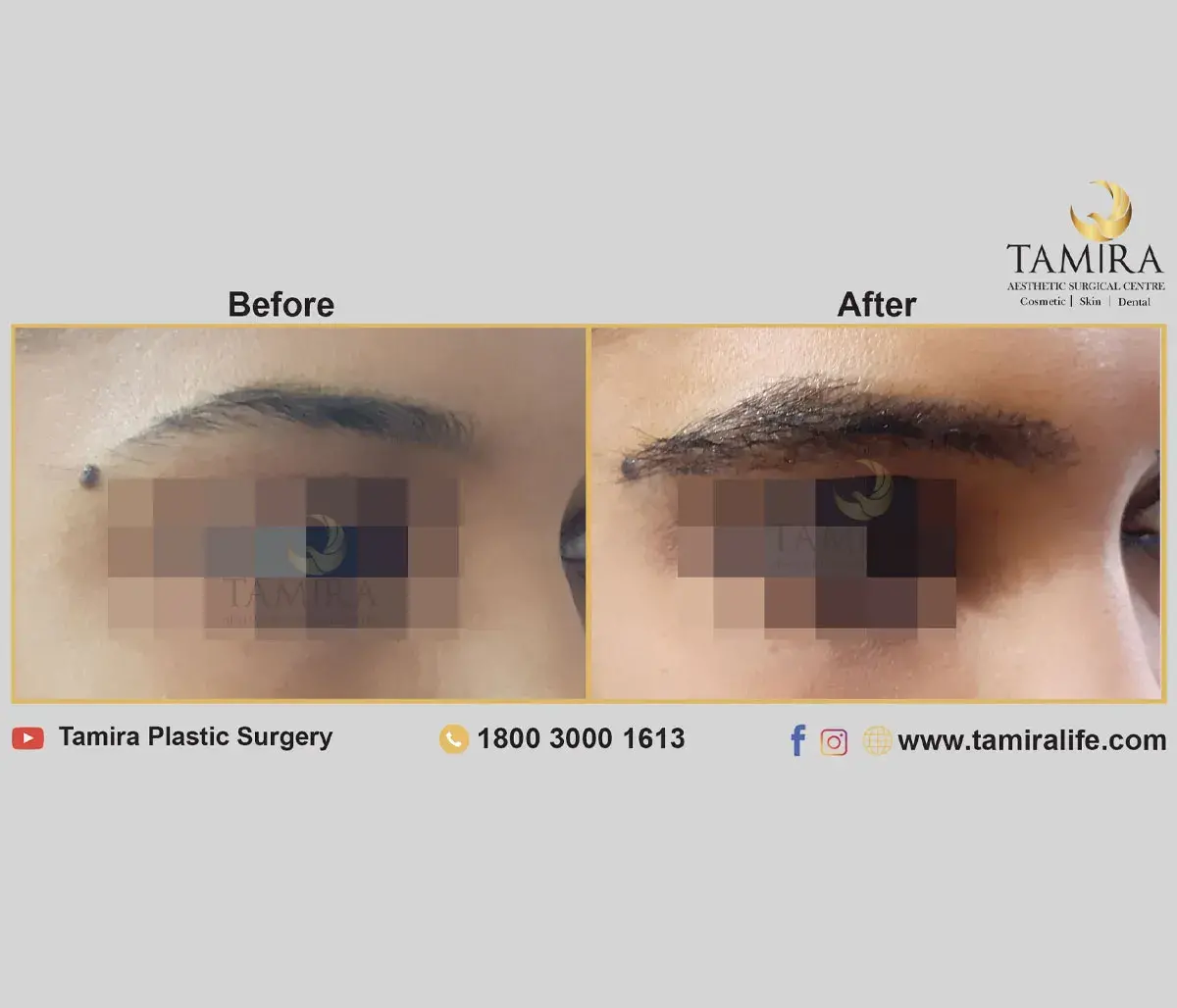 Eyebrow Hair Transplant - Eye Brows - Before & After