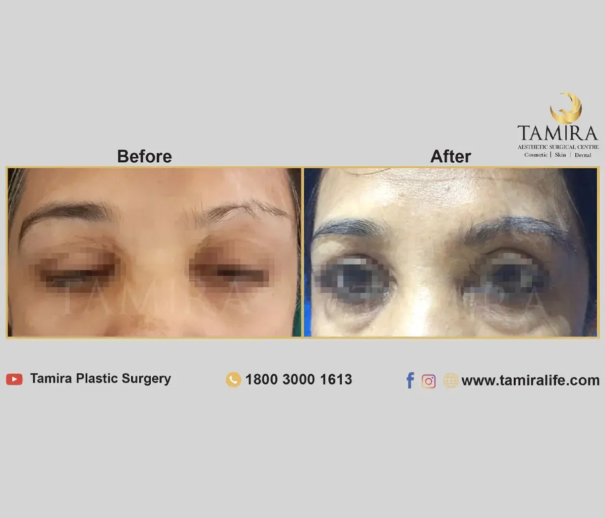 Eyebrow Hair Transplant - Eye Brows - Before & After