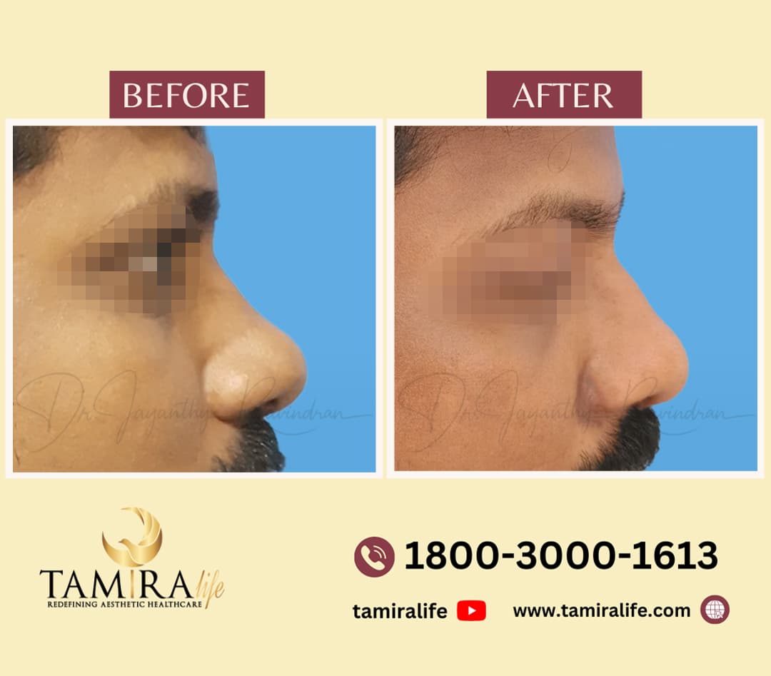 Rhinoplasty