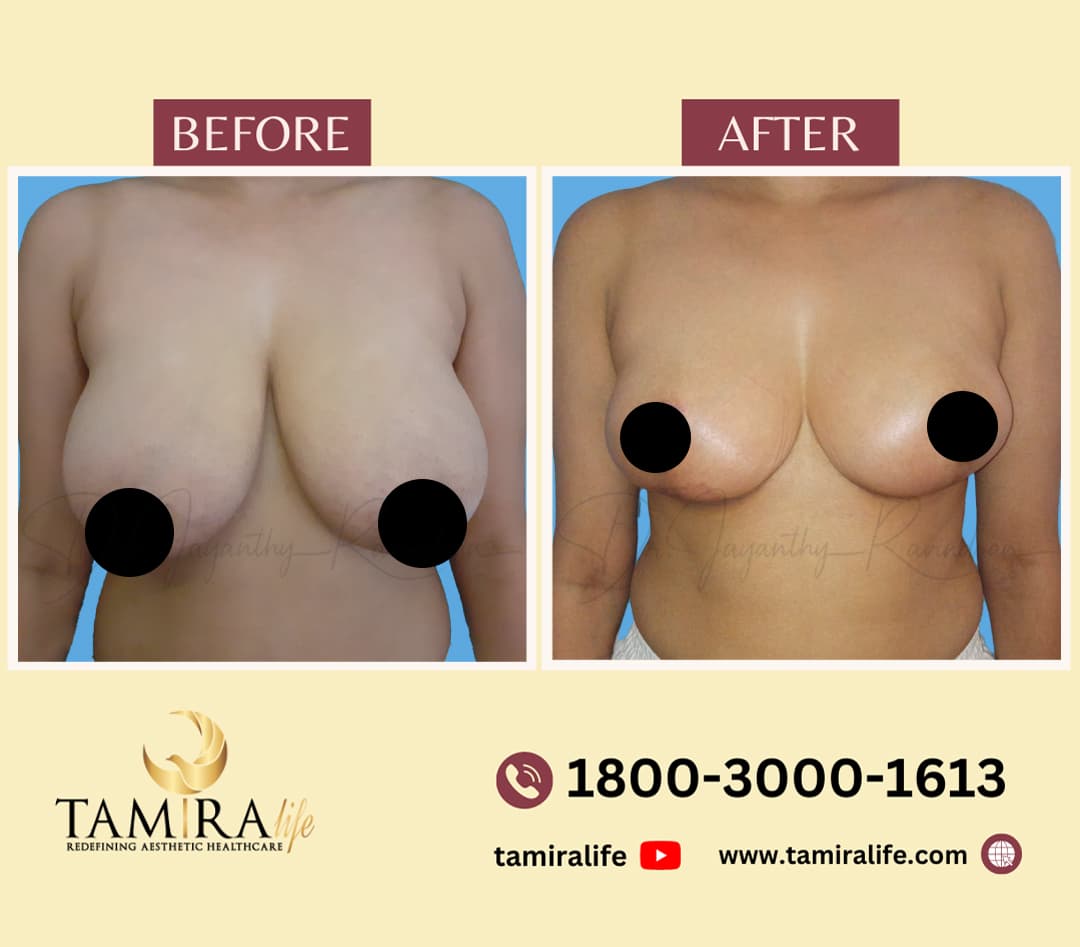 Breast Reduction