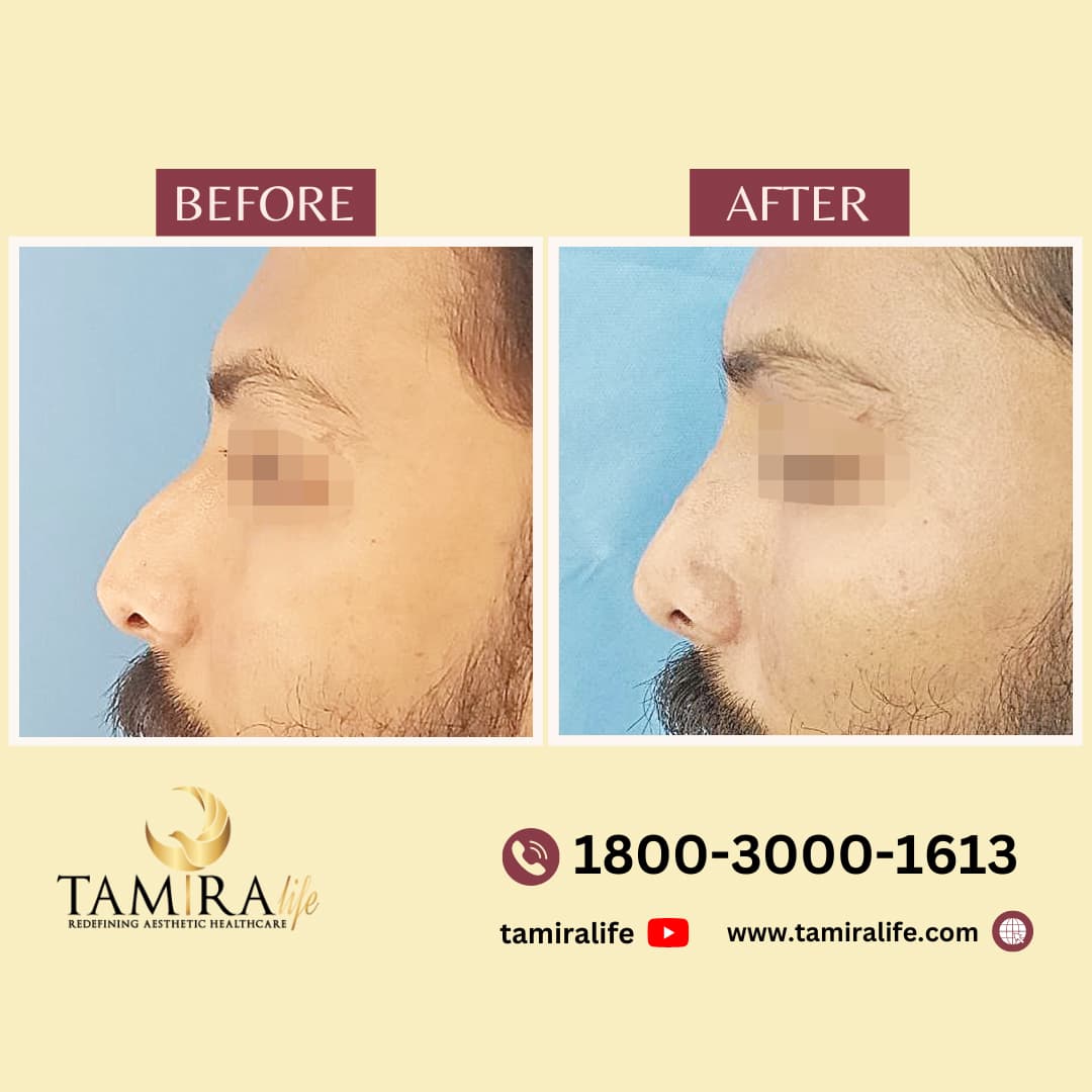 Rhinoplasty