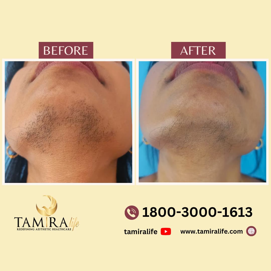 Laser Hair Removal