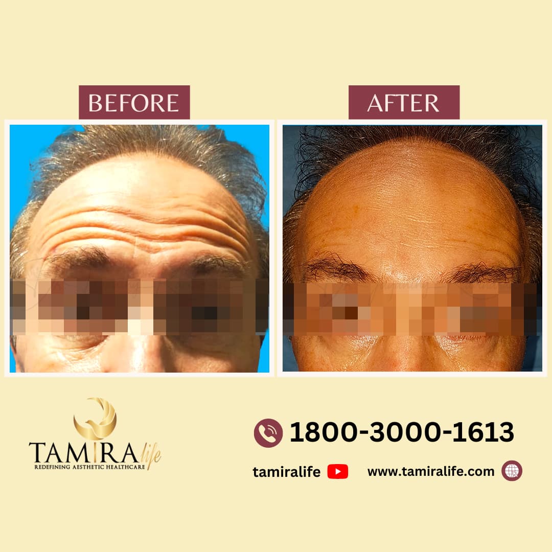 botox 