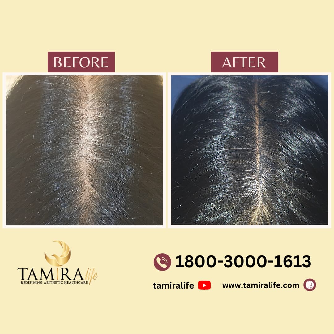 Scalp Micropigmentation